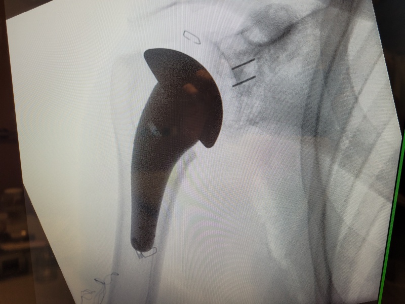 Ein Röntgenbild das eine rechte  Schulter-Totalendoprothese zeigt (Schulter-TEP)